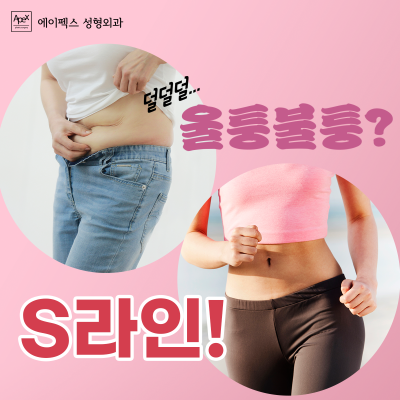 뱃살, 옆구리살, 에이펙스성형외과에서 지방흡입으로 매끈하게 정리햇!